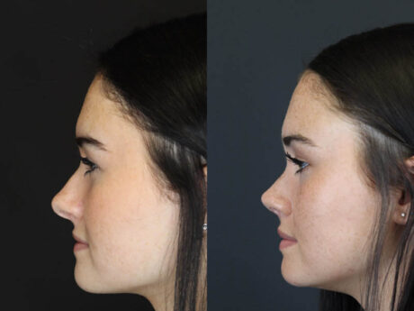 Rhinoplasty case #4321