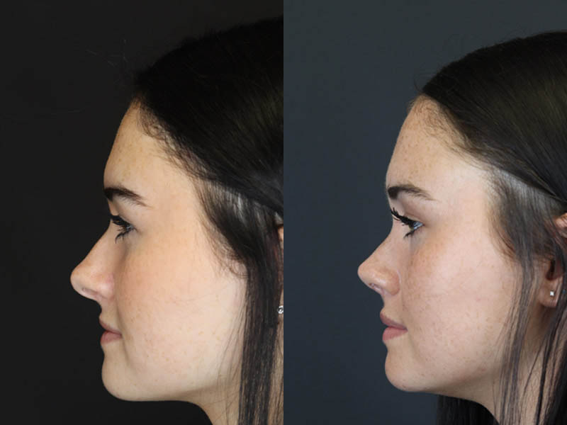 Rhinoplasty case #4321