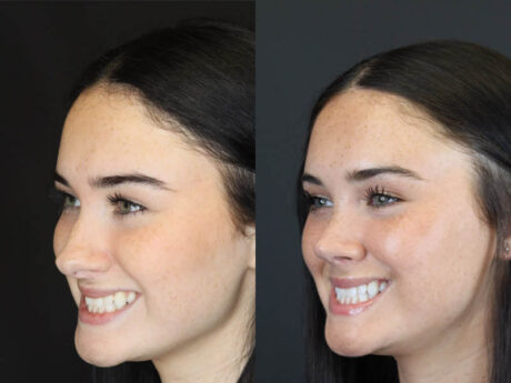 Rhinoplasty case #4321