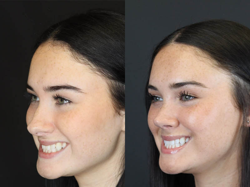 Rhinoplasty case #4321