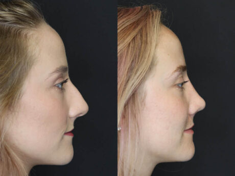 Rhinoplasty case #4334