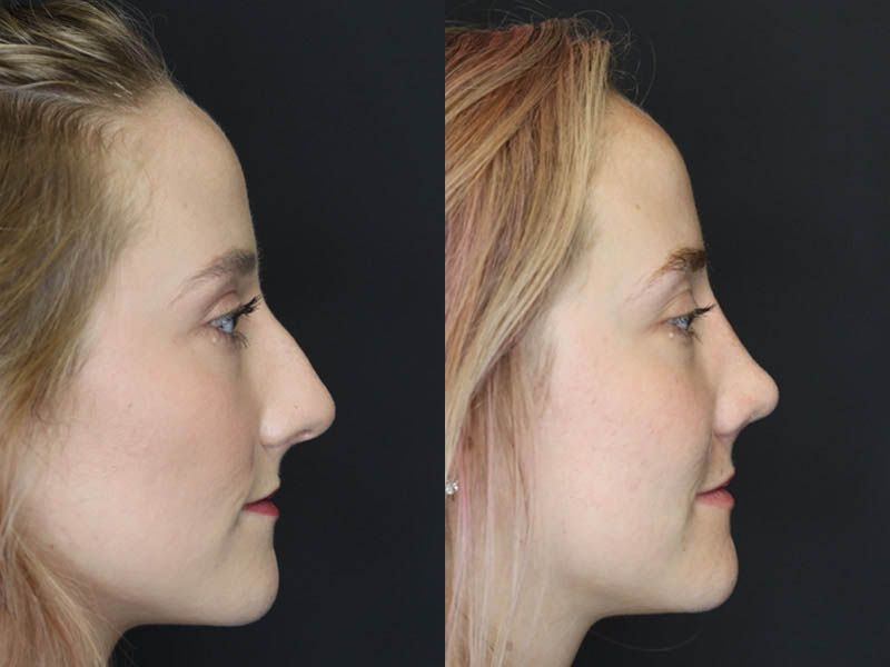 Rhinoplasty case #4334