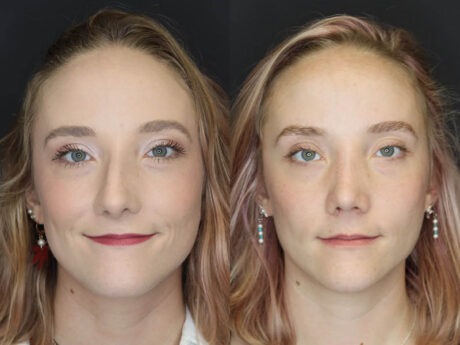 Rhinoplasty case #4334