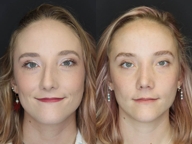 Rhinoplasty case #4334