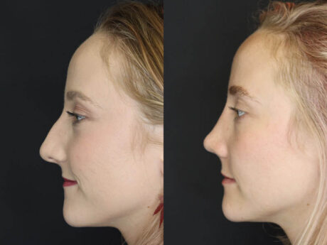 Rhinoplasty case #4334