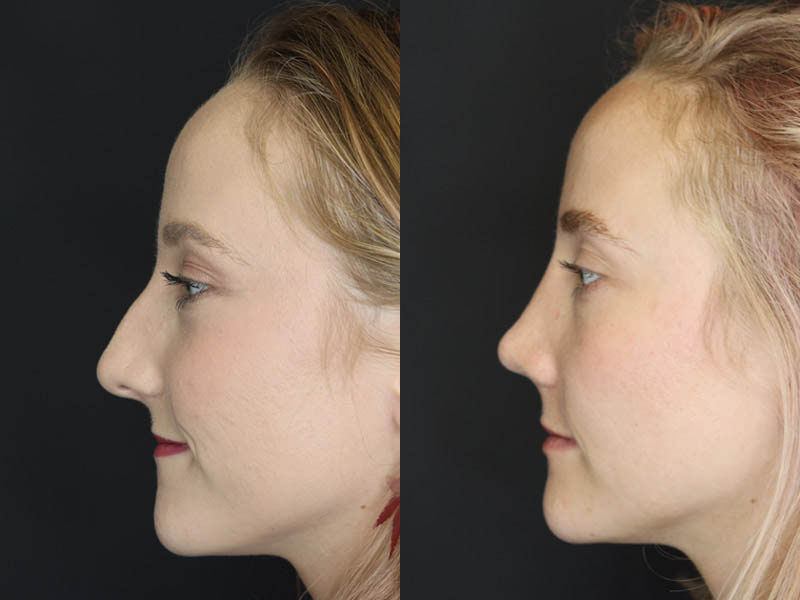 Rhinoplasty case #4334