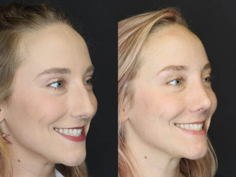 Rhinoplasty case #4334