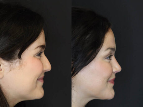 Rhinoplasty case #4354