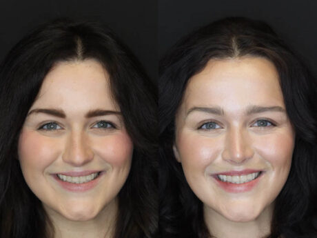 Rhinoplasty case #4354