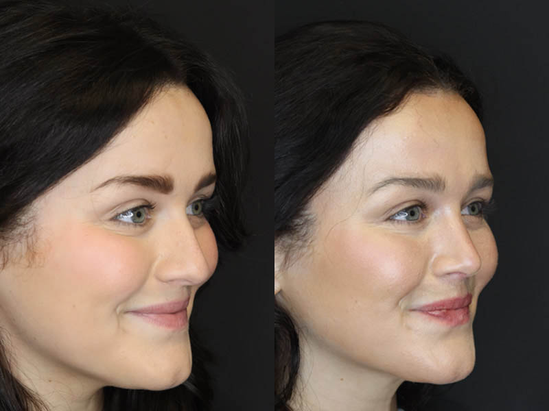 Rhinoplasty case #4354