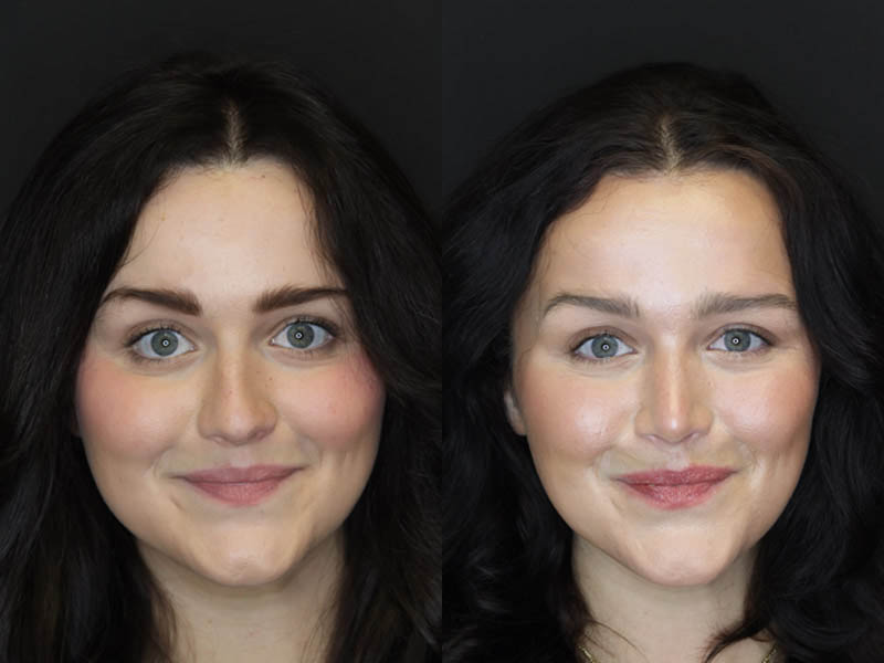 Rhinoplasty case #4354