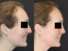 Rhinoplasty case #4367 slider thumbnail