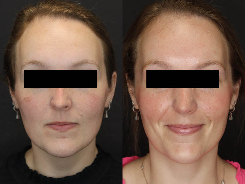 Rhinoplasty case #4367