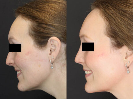 Rhinoplasty case #4367