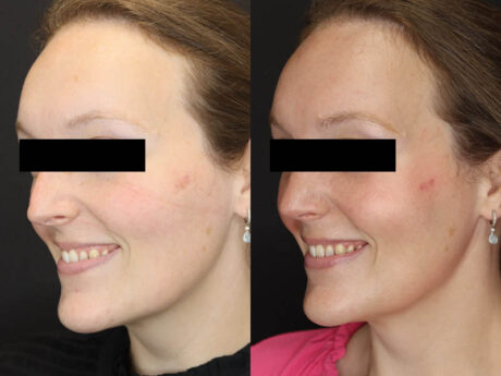 Rhinoplasty case #4367