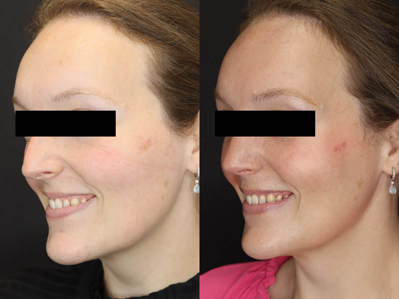 Rhinoplasty case #4367