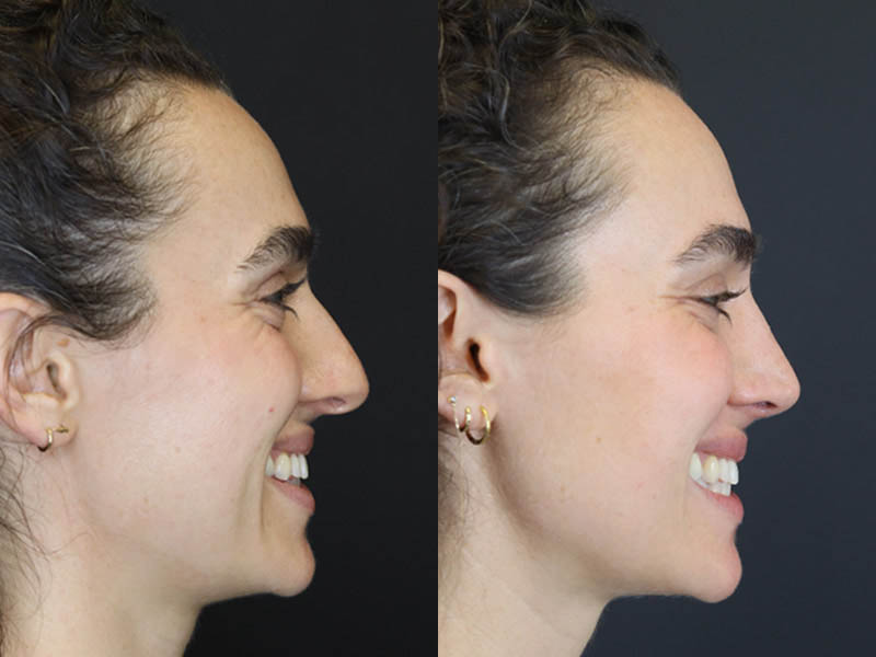 Rhinoplasty case #4383