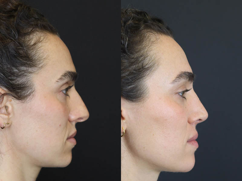 Rhinoplasty case #4383