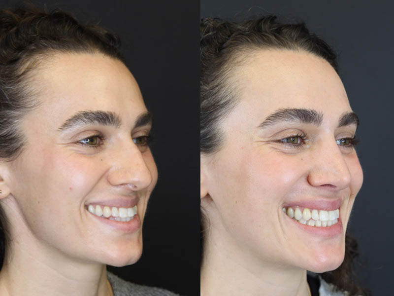 Rhinoplasty case #4383