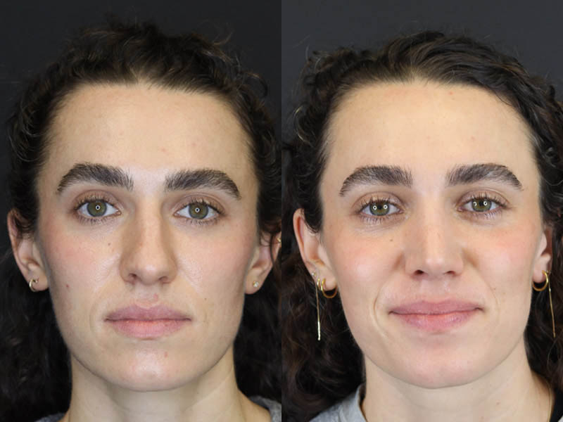 Rhinoplasty case #4383