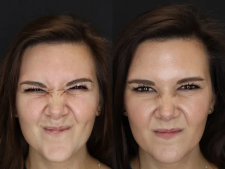 Neuromodulator case #4314