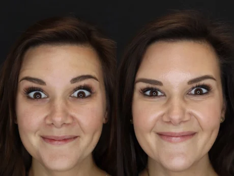 Neuromodulator case #4314