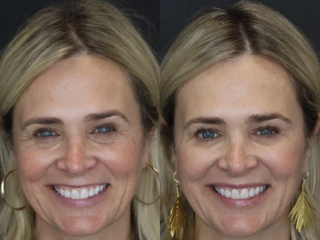 Neuromodulator case #4378