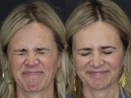 Neuromodulator case #4378