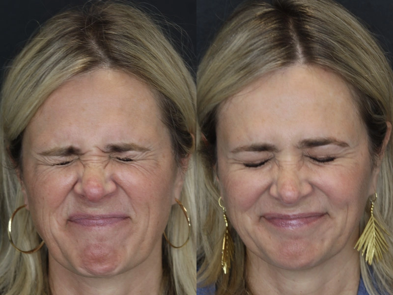 Neuromodulator case #4378