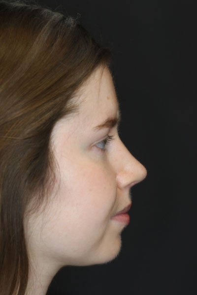 Rhinoplasty case #3946