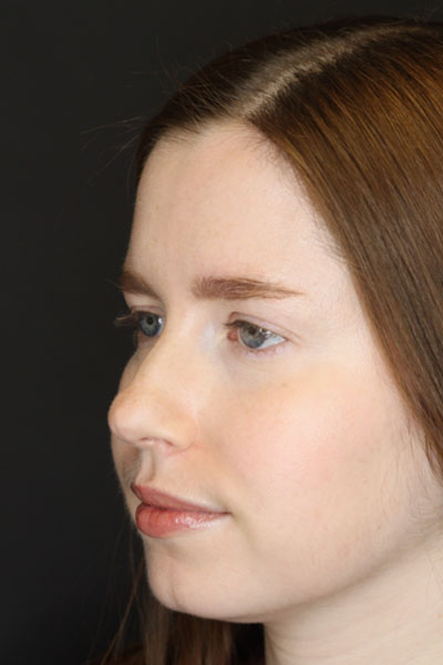 Rhinoplasty case #3946