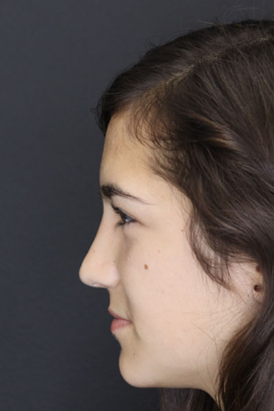 Rhinoplasty case #3967