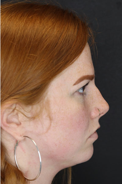 Rhinoplasty case #3997