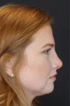 Rhinoplasty case #3997