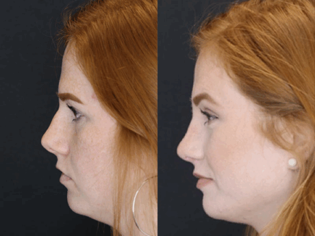 Rhinoplasty case #3997