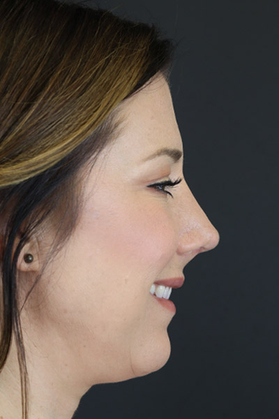 Rhinoplasty case #4252