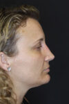 Rhinoplasty case #4265