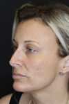 Rhinoplasty case #4265