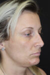 Rhinoplasty case #4265