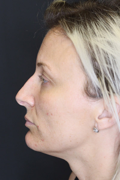 Rhinoplasty case #4265