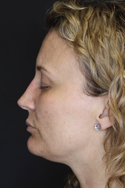 Rhinoplasty case #4265