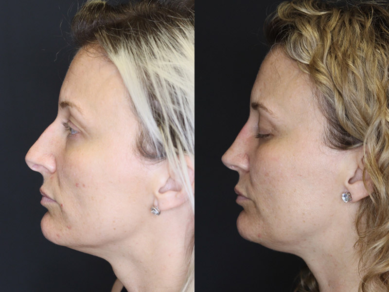 Rhinoplasty case #4265