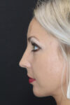 Rhinoplasty case #4191