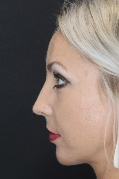 Rhinoplasty case #4191