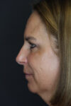 Rhinoplasty case #4212