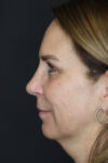 Rhinoplasty case #4212