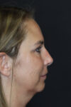 Rhinoplasty case #4212