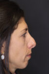 Revision Rhinoplasty case #4230