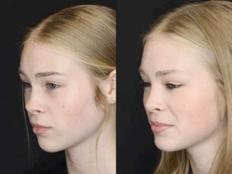 Rhinoplasty case #3947