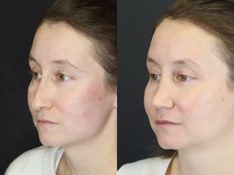 Rhinoplasty case #4104